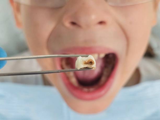 Best Emergency Tooth Extraction in Felida, WA