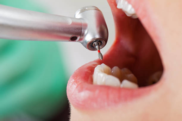 Best Emergency Treatment for Toothache in Felida, WA